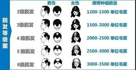 脱发等级 脱发等级